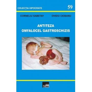 Antiteza omfalocel gastroschizis - Corneliu Sabetay, Ovidiu Ciobanu